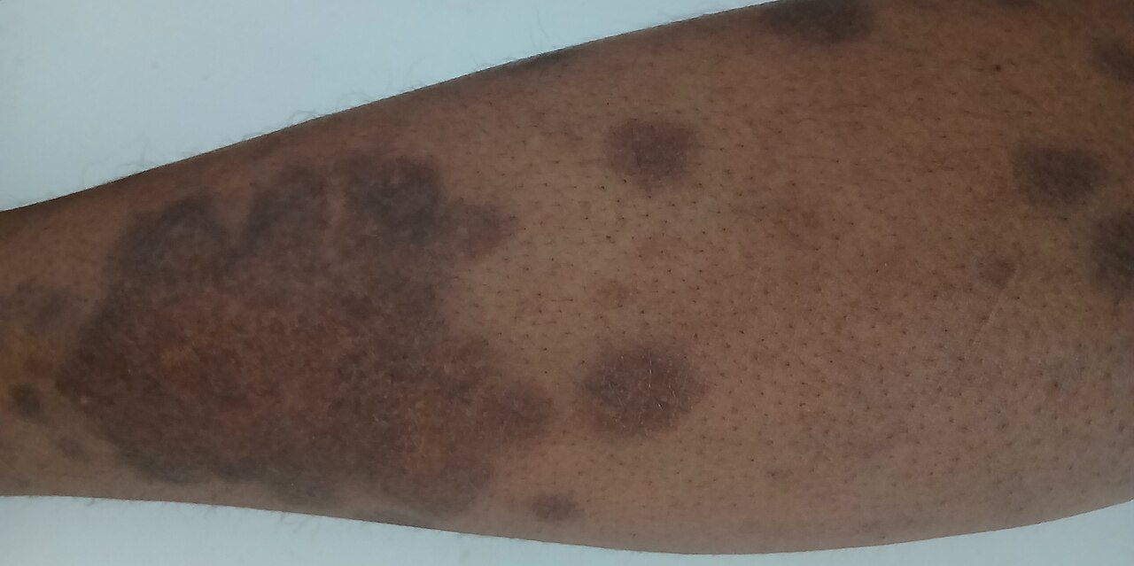 Parches oscuros de psoriasis sobre la piel de la pierna de una persona de piel morena