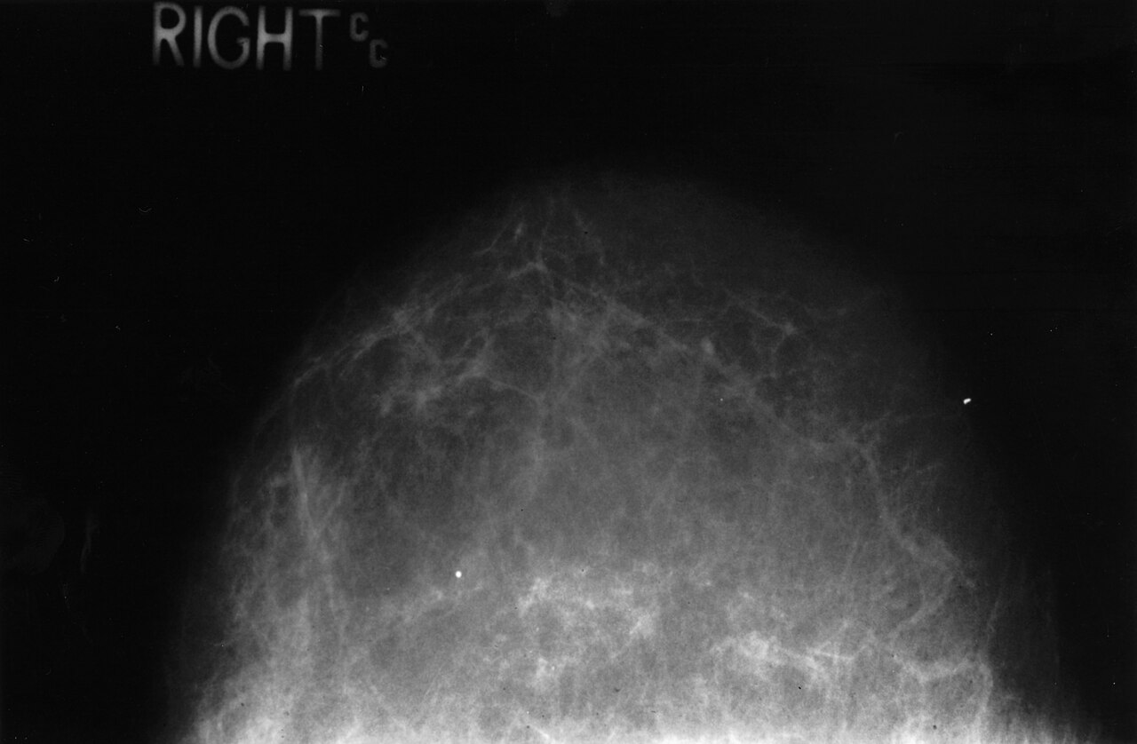 Mamografía en blanco y negro de una mama con tejido graso, con la indicación RIGHT CC en la esquina superior